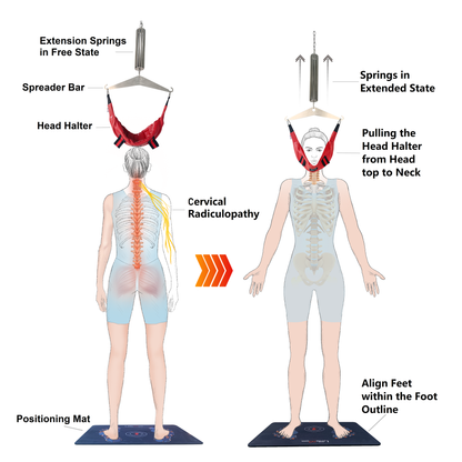 Home cervical traction device for cervical radiculopathy and arm symptoms