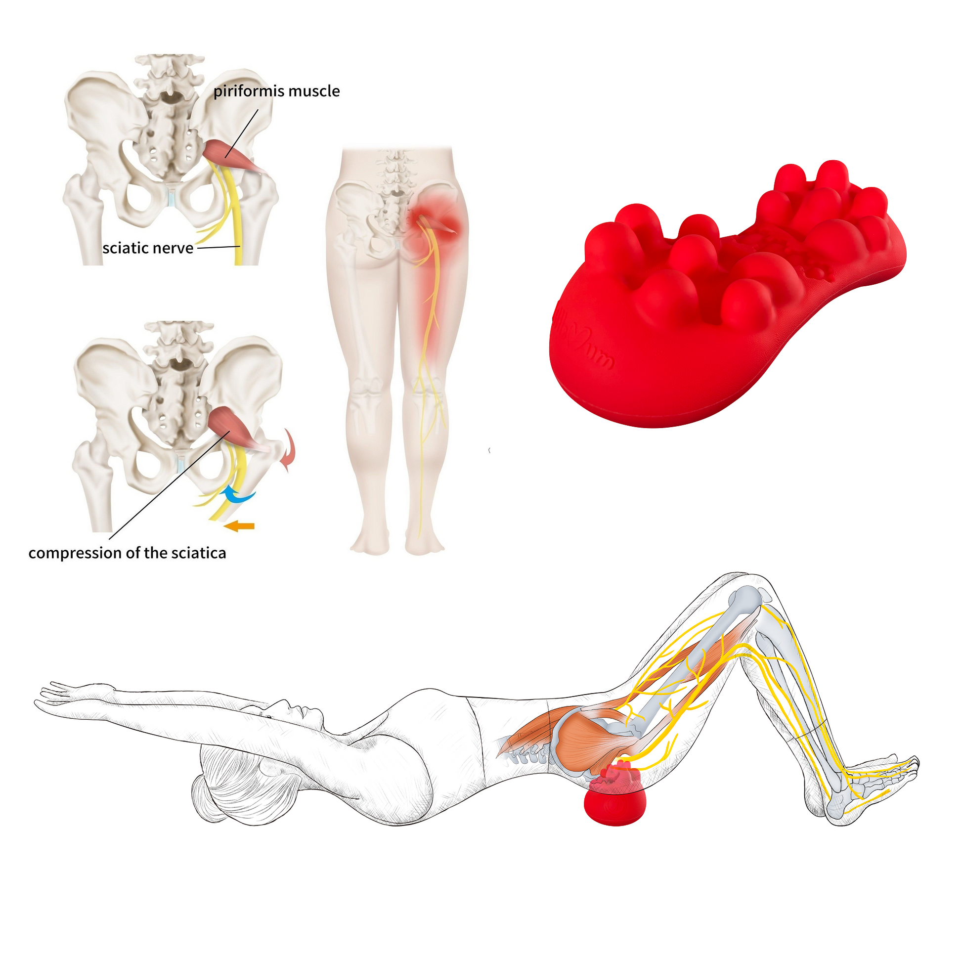 Piriformis trigger points and sciatica-related glute massage position