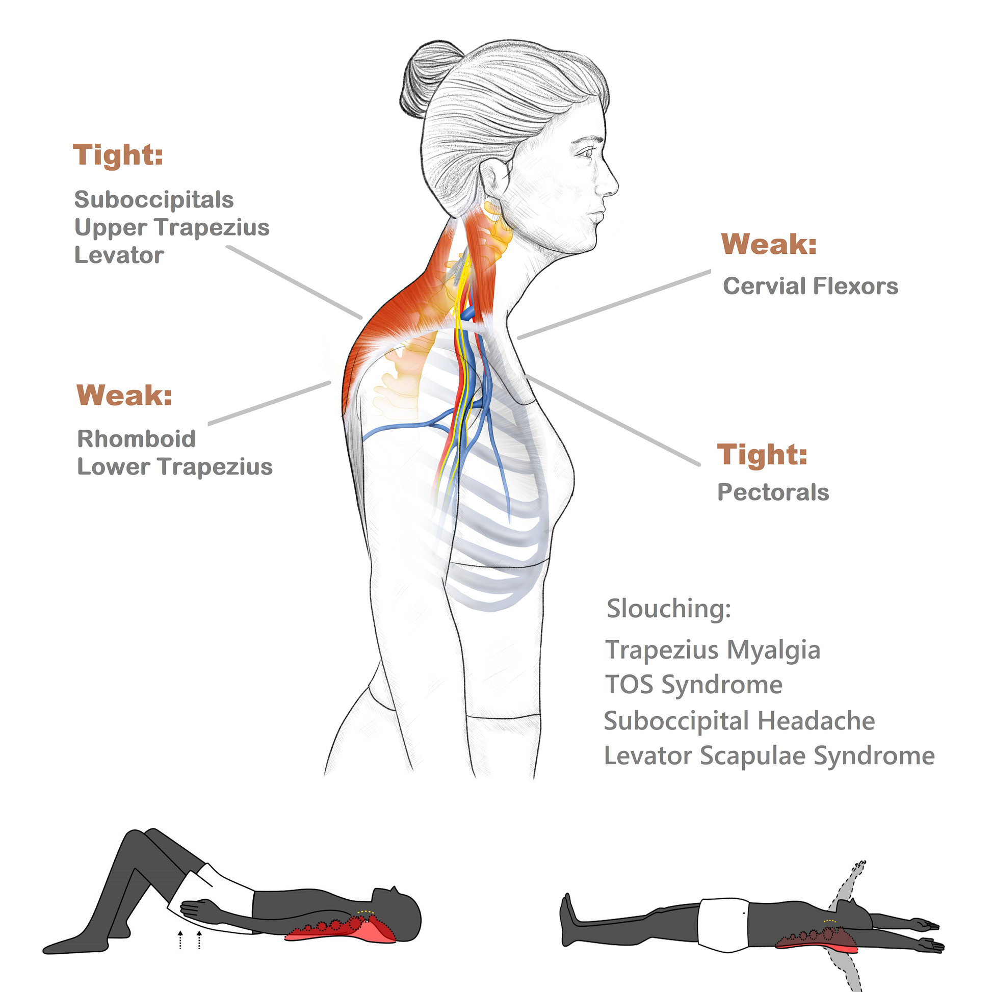 Forward-head posture and trapezius myalgia muscle diagram
